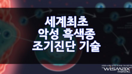 세계최초 악성 흑색종 조기진단 기술?